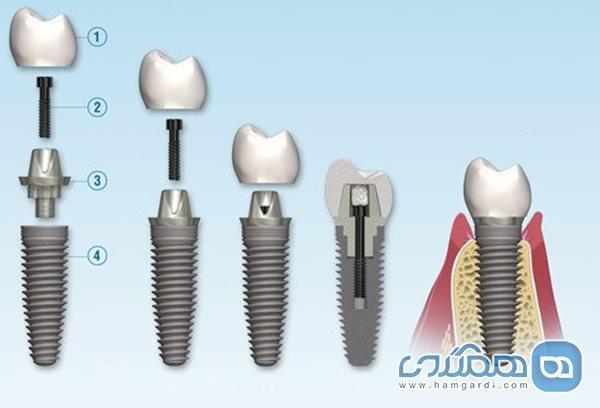 انواع ایمپلنت دندان؛ تفاوت و هزینه آنها