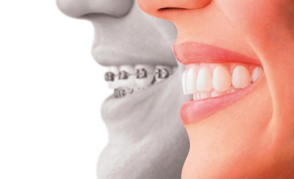 چگونه دندان های مرتب داشته باشیم؟